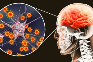 meningitis