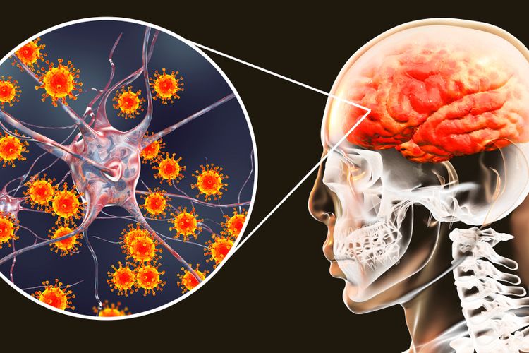 meningitis