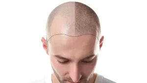 Implan Rambut,