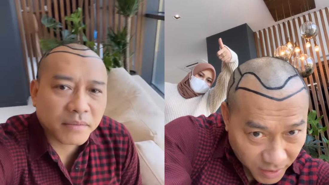 implan rambut 