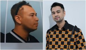 transplantasi rambut