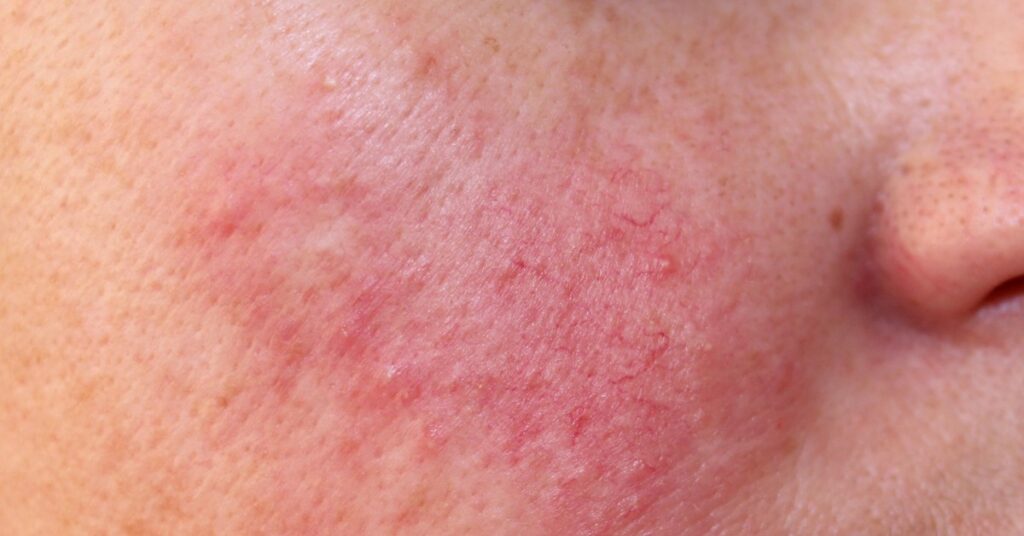 retinol