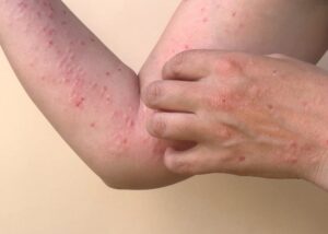 Aplikasi Satu Sehat Cegah Mpox