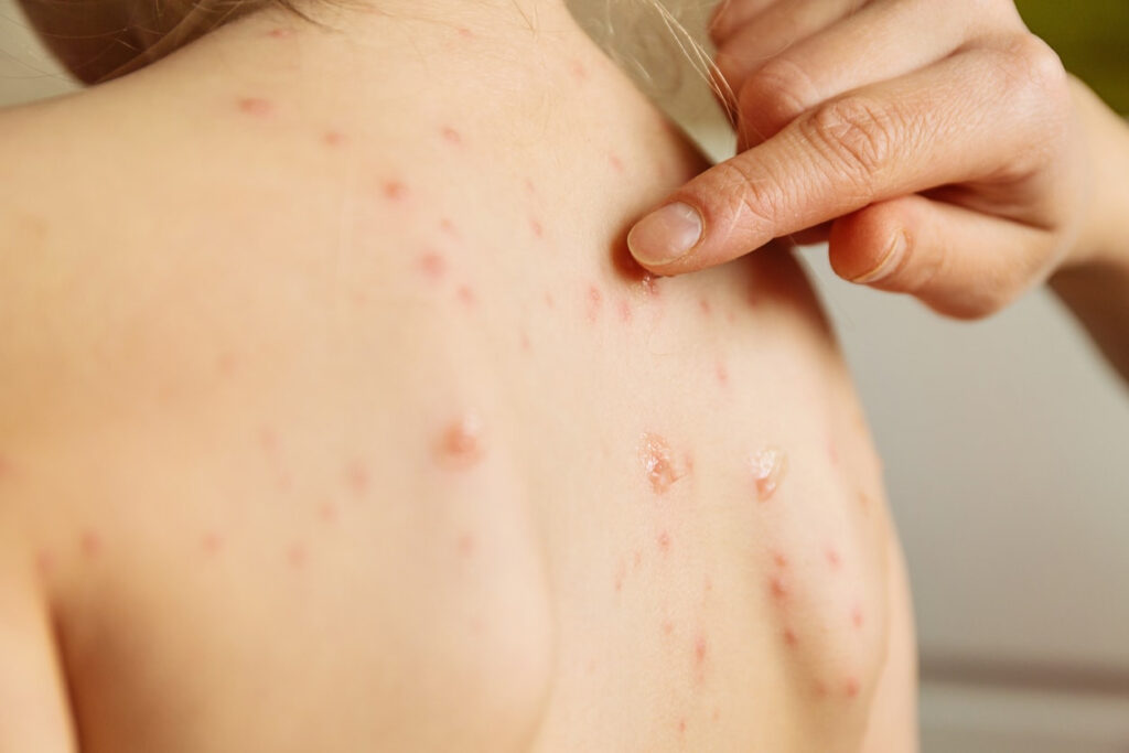 virus cacar monyet