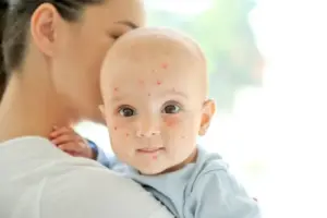 Virus cacar monyet