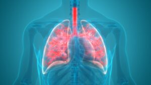 Penyakit Pneumonia