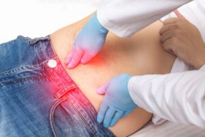 Hernia