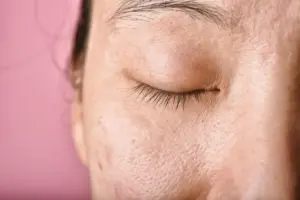 kulit kering saat puasa