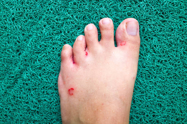 Kurap di kaki