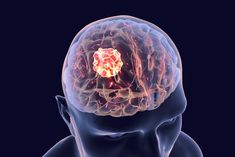 Operasi tumor otak