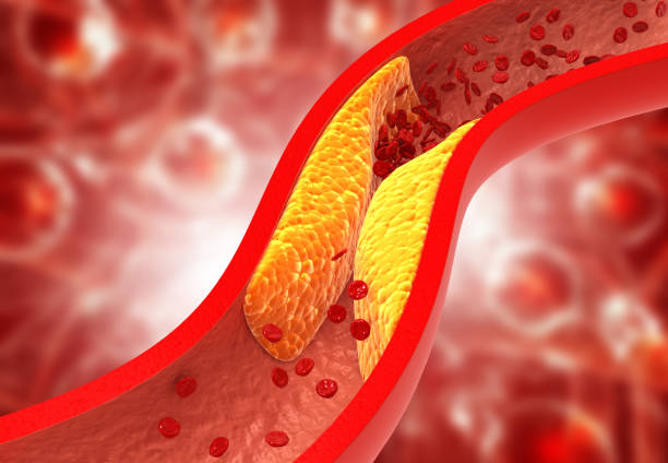 arteriosklerosis.jpg